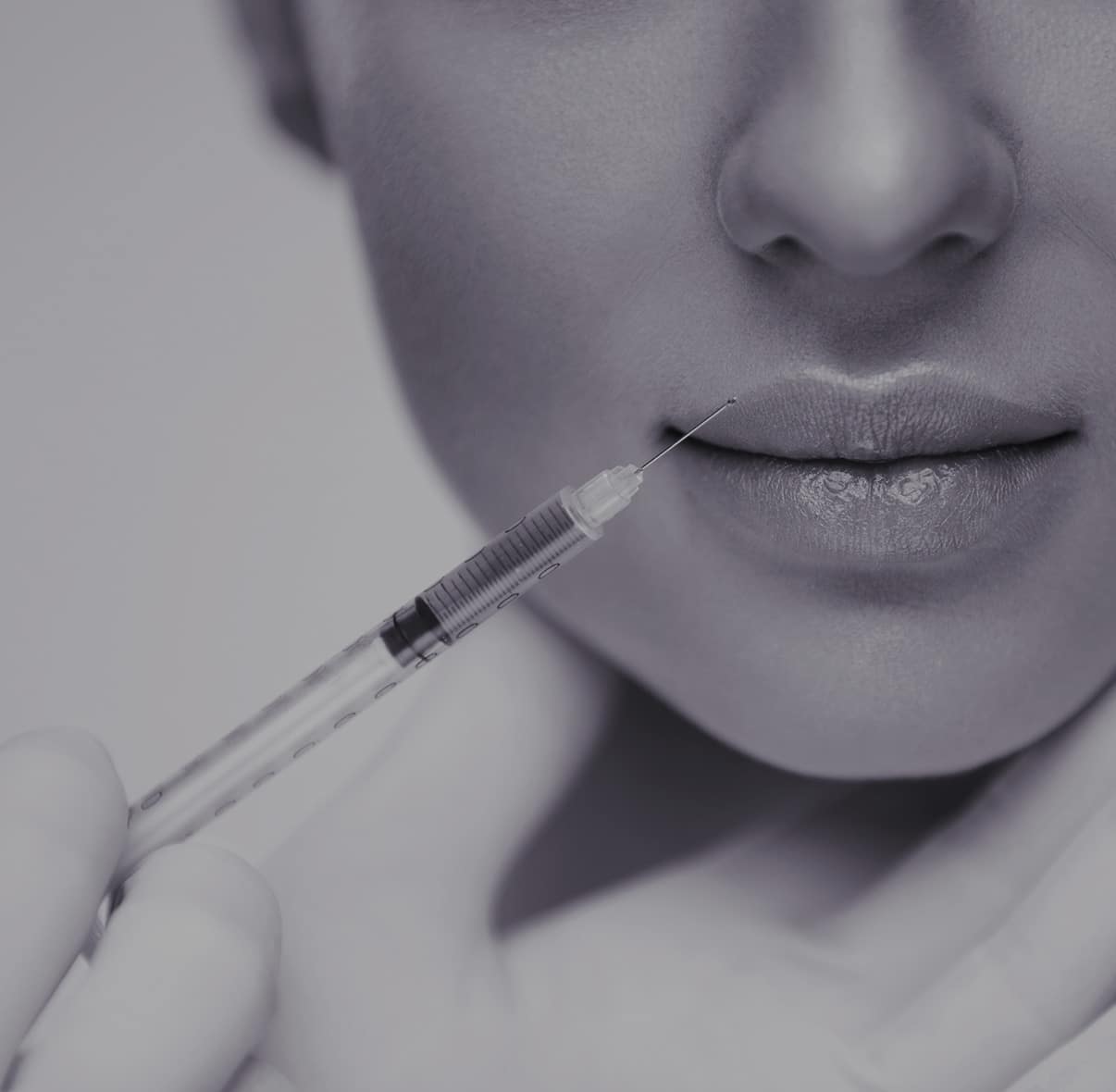 Injection d'acide hyaluronique lèvres - augmenter le volume à Paris - Dr Liwarek
