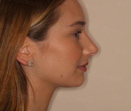 Photo de profile gauche du visage apres rhinoplastie Dr Liwarek Paris