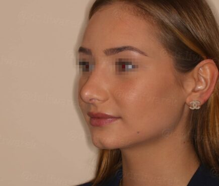 Photo de profile gauche du visage apres rhinoplastie Dr Liwarek Paris