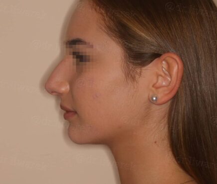Photo de profile gauche du visage avant rhinoplastie Dr Liwarek Paris