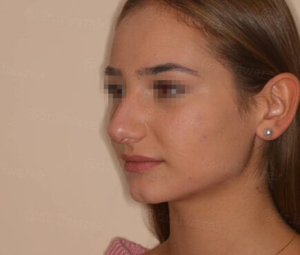 Photo de profile gauche du visage avant rhinoplastie Dr Liwarek Paris
