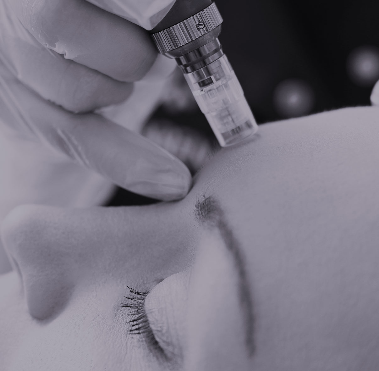Le dispositif microneedling pour traitement des cicatrices et vieillissement cutane Dr Liwarek Paris
