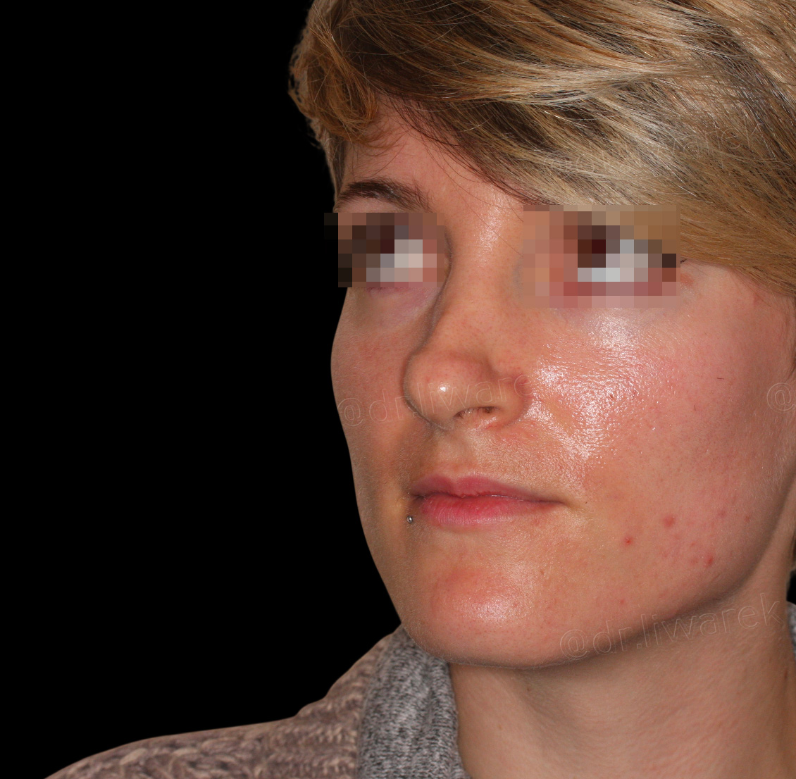 Visage de femme avant rhinoplastie secondaire structurelle par voie externe Dr Liwarek Paris