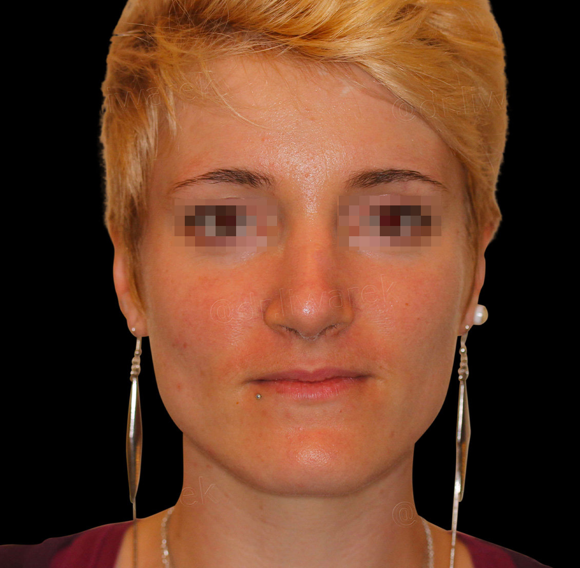 Visage de femme profil face apres rhinoplastie secondaire par voie externe Dr Liwarek Paris