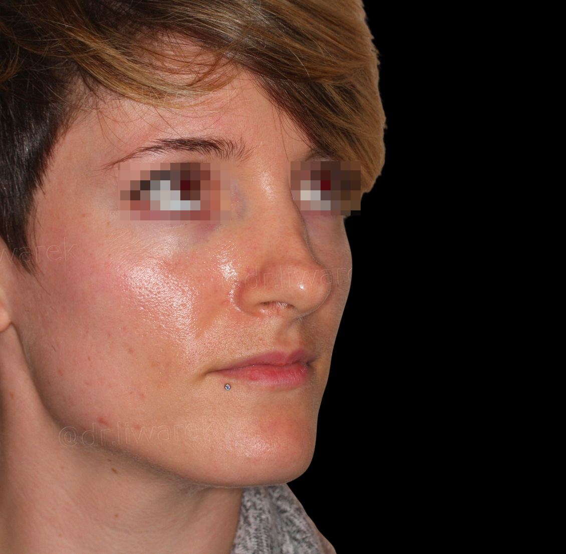 Visage de femme profil droit avant rhinoplastie secondaire par voie externe Dr Liwarek Paris